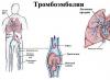 Tromboembolism i lungartären (PE) Tecken på vaskulär tromboembolism