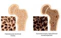 Osteoporoza gjatë shtatzënisë: simptomat, shkaqet, trajtimi, parandalimi, komplikimet Osteoporoza pas shtatzënisë