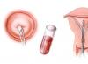 Podstata cytologické analýzy a její aplikace v gynekologii