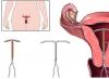 Pajisja intrauterine: llojet, indikacionet dhe kundërindikacionet