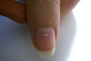 Hur man blir av med vita fläckar på naglarna hemma