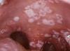 Trichomoniasis in the mouth Treatment Oral Trichomonas routes of infection