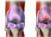 Osteoartróza: klasifikace, příčiny, příznaky, léčba